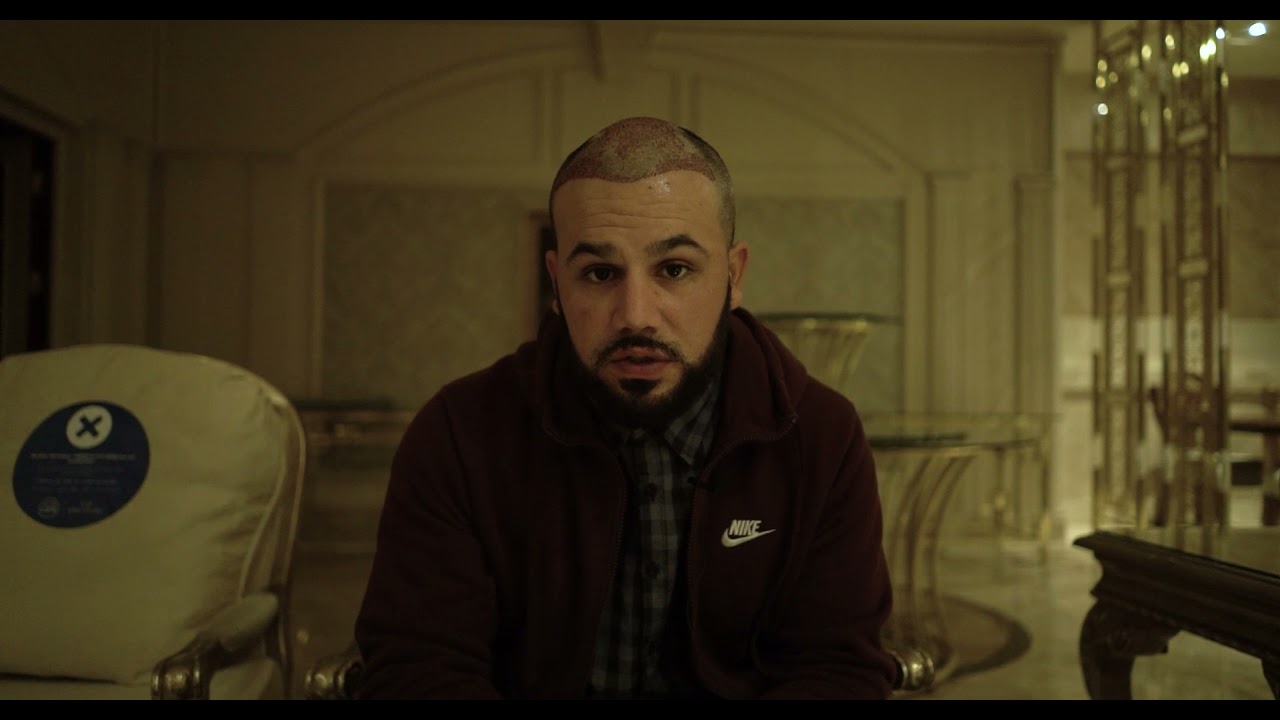 1 Vip Operation by Dr Caymaz in Hair Upload Hair Transplant Clinic | Turkey