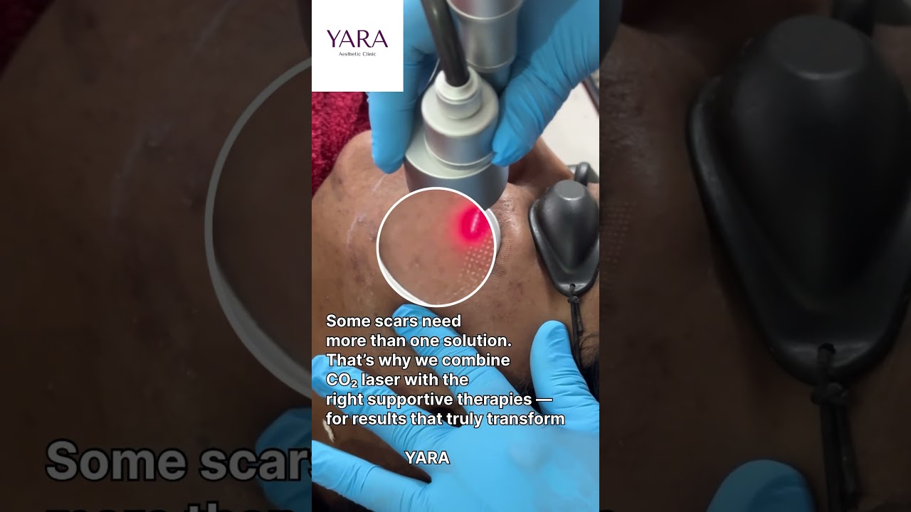 Best Treatment for Acne Scars: CO2 Laser with Multi‑Modal Approach 