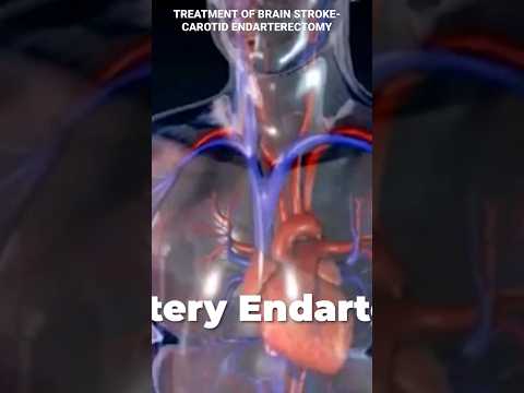 Video: Provjerava li angiogram karotidnu arteriju?