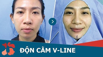 Cận cảnh một ca phẫu thuật độn cằm V Line