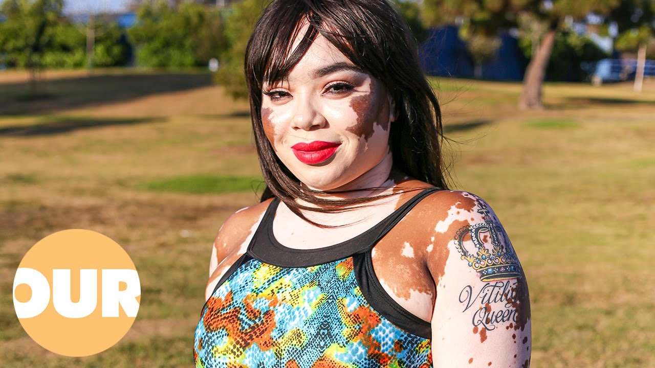 'Vitiligo Queen' Proudly Owns Her Condition (Born Different) | Our Life