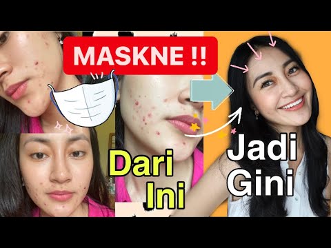 Video: Apa Itu 'Maskne?': Cara Mencegah Jerawat Dari Memakai Masker Wajah