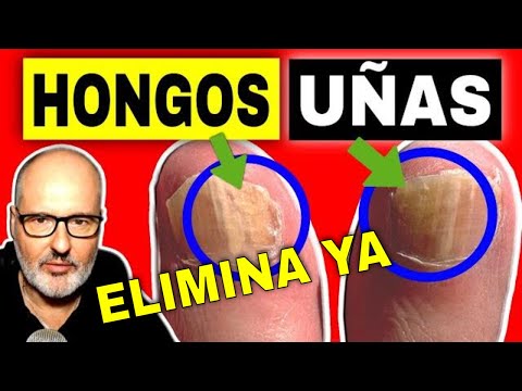 Video: Cómo curar los hongos en las uñas: 14 pasos (con imágenes)