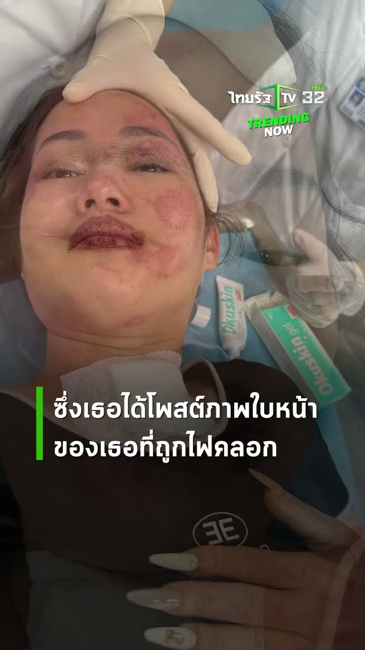 สาวเวียดนามช็อก! ลูกโป่งระเบิดใส่หน้า ไฟคลอกจนเสียโฉม