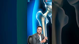 Cemented vs Uncemented Hip Implants: Which is Better? | Dr. Debashish Chanda
