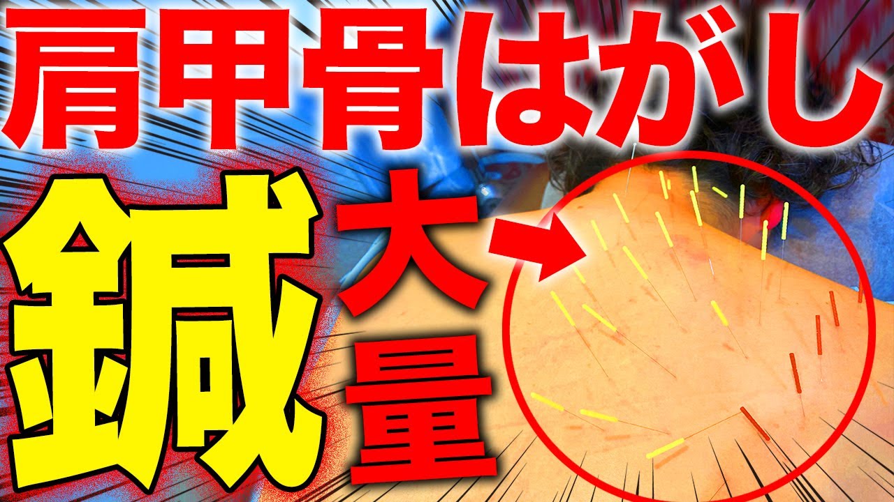 【肩甲骨はがし】肩甲骨はがしに大量の鍼って一体？効果あるのか、実はたった２本の鍼で。。。【東京銀座　横浜元町　鍼灸】