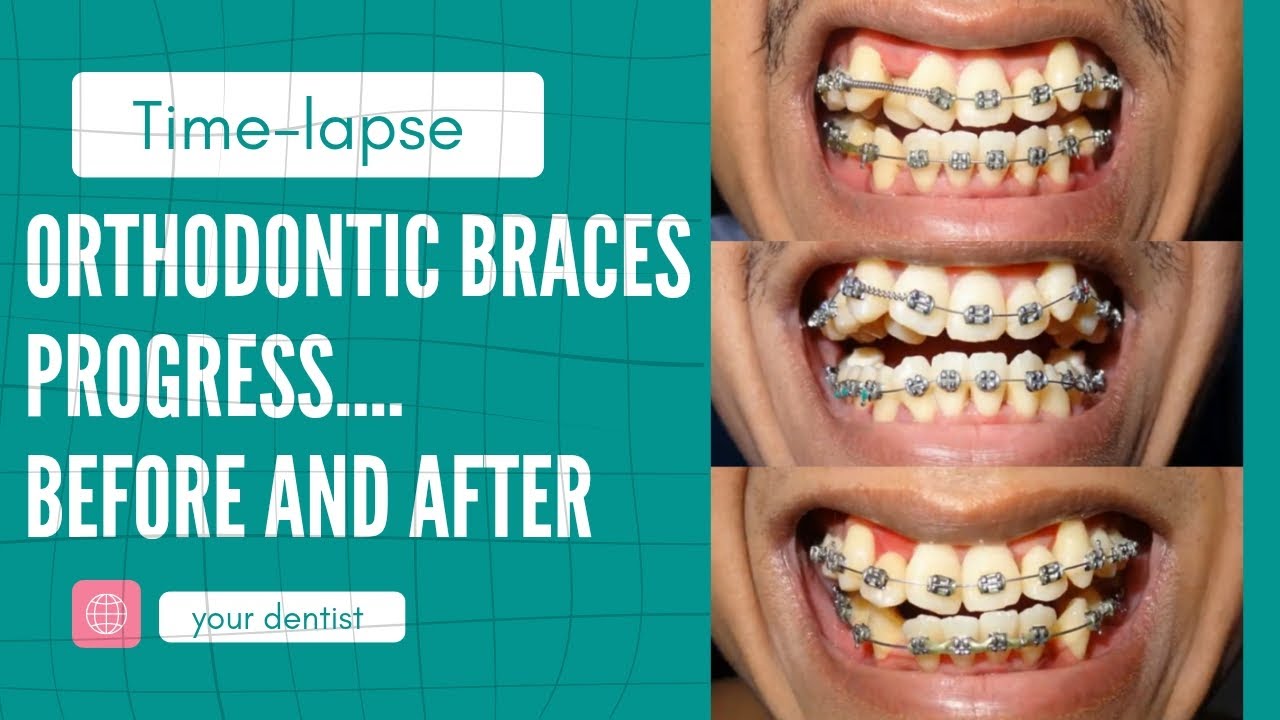 Braces Before and after treatment progress timelapse Orthodontic