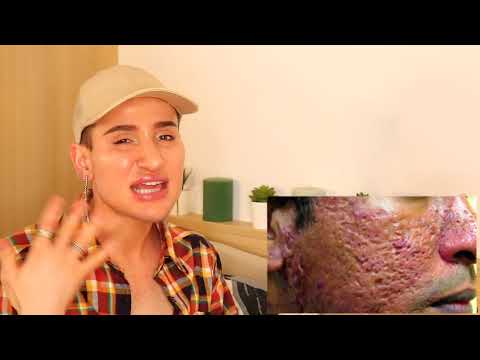 5 ways to remove acne scars - 5 ways to remove acne scars