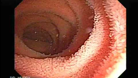 O que pode causar estreitamento do intestino?