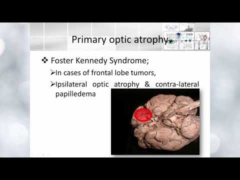 Video: Delvis Optisk Nerveatrofi