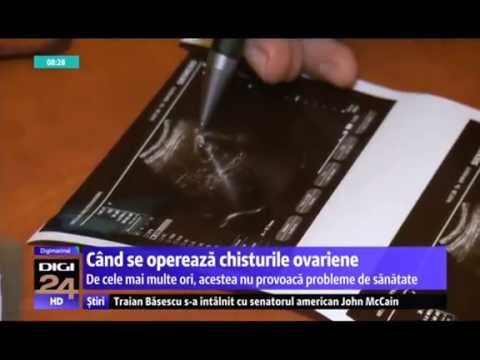 Cand se opereaza chisturile ovariere, dr. Ion Daniel, Digi 24