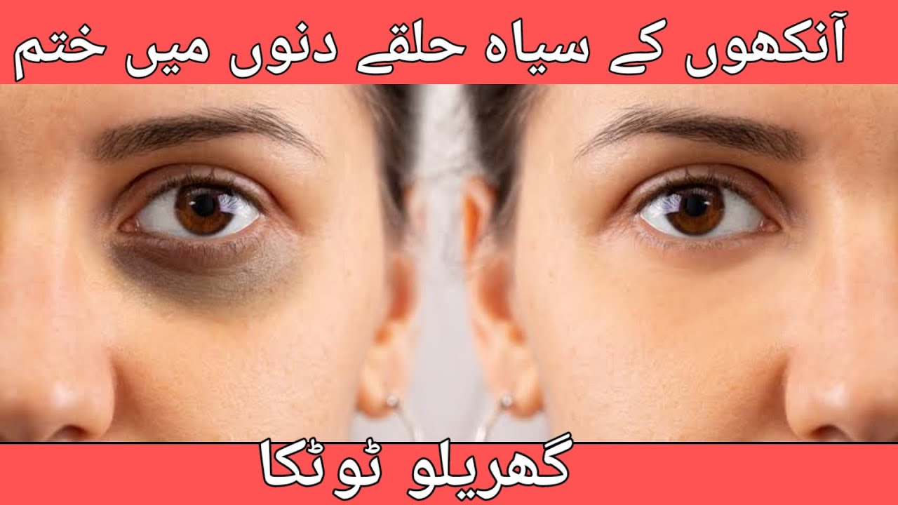 how to remove dark circles around eyes at home||how to remove dark