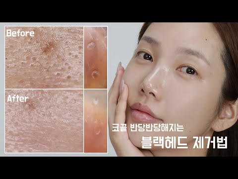 블랙&amp;amp;화이트헤드 이렇게 없애요! 지성피부 필수!
