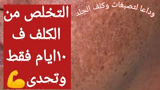 اقوى وصفه طبيعيه لعلاج الكلف وتصبغات الوجه والرقبه٢٠٢١مجربه ومضمونه١٠٠٪ #علاج_الكلف_تصبغات_الوجه