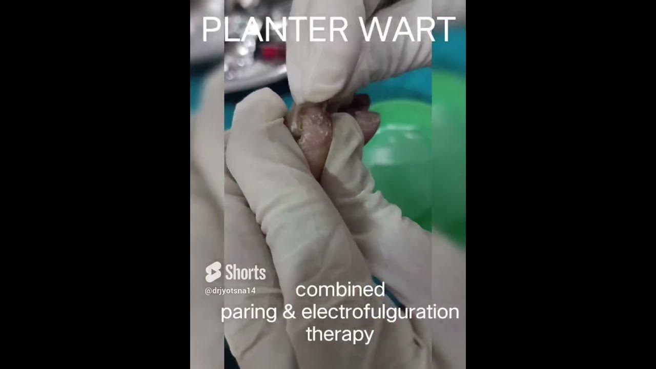 Planter Wart Removal by Paring and electrofulguration YouTube