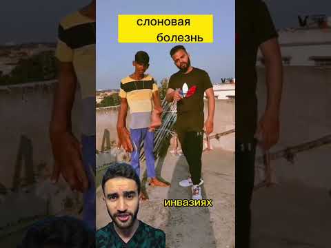 дядя, зачем тебе такие большие руки? или слоновая болезнь