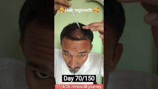 Day 70/150 Mintop Alcohol Free Minoxidil Journey | Real Results | 17 April