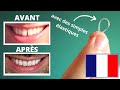 Réduire l'écart entre les Dents Du Bonheur en 40 JOURS (SANS appareil dentaire!)