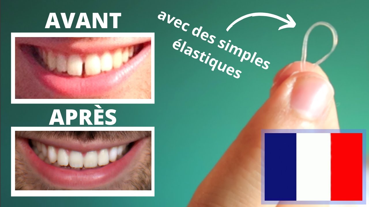 Réduire l'écart entre les Dents Du Bonheur en 40 JOURS (SANS appareil  dentaire!) - YouTube