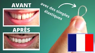 Réduire Lécart Entre Les Dents Du Bonheur En 40 Jours Sans Appareil Dentaire