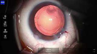 OS 2026 06 08 131305 c Phaco  limbal stem cell insufficiency