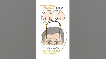 Upper Vs Lower Motor Neurone Facial Weakness