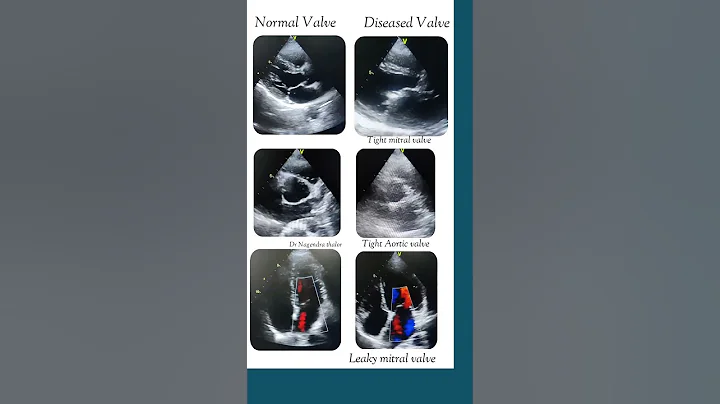 Normal v/s Diseased heart valve in echo( Tight & Leaky valve) #echo #shorts