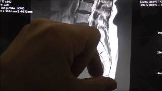 Coccydynia - Spine Plus Clinics - www.spineplus.co.uk Case 1056 Mri Mechanical Coccydynia
