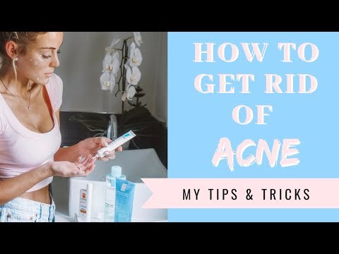 How to Get Rid Of Acne |  My Tips & Tricks