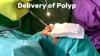 Huge Nasal Polyp removal Surgery.