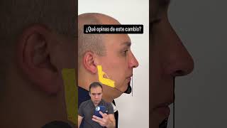 Rinoplastia Íaestética