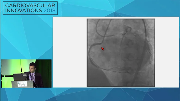 CVI2018 Session: Microcatheter entrapment - Wissam...