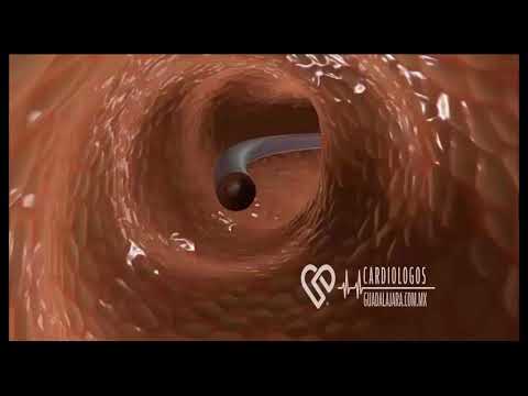 Video: Cómo limpiar un sitio de cateterismo cardíaco: 14 pasos
