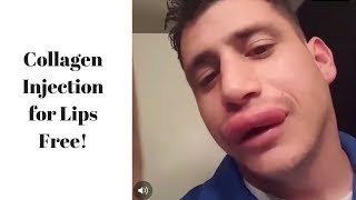 Collagen Lip Injection, Free! I Giggles and Laughter Compilation screenshot 2