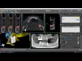 How to make a combination bone and tooth/tissue supported surgical guide