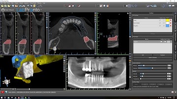 How to make a combination bone and tooth/tissue supported surgical guide