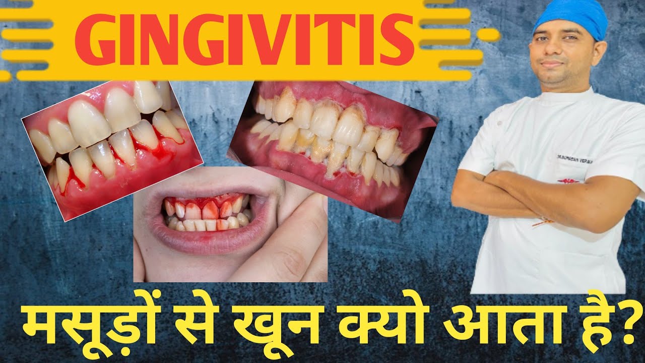 मसूड़ों से खून क्यों आता है🤔।। masudo me khoon aane ka karan ...