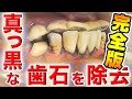 [完全版]真っ黒な歯石を除去 Remove black TARTAR(去除全黑的牙石)[お掃除]