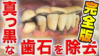 [完全版]真っ黒な歯石を除去 Remove black TARTAR(去除全黑的牙石)[お掃除]