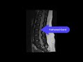 Lspine mri spinal bifida with tethered cord