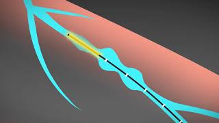 Dr Toby Cohen - Varicose Vein Surgery