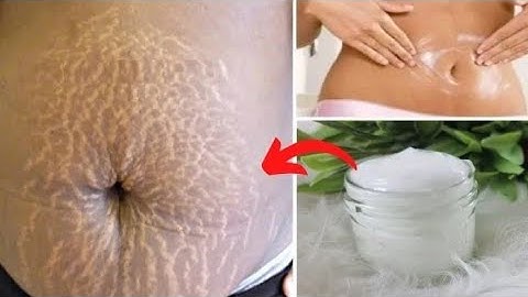 In 3 Days Remove Stretch Marks Completely World