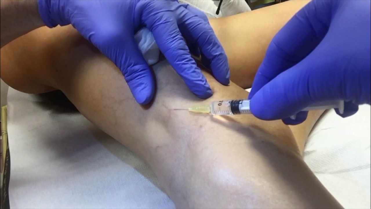 Microsclerotherapy Microsclerotherapy. The only effective treatment to get rid of thread ...