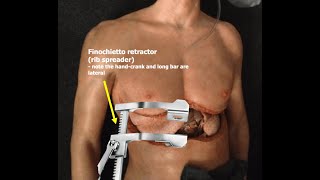 CPT code for Thoracotomy - simplify medical coding