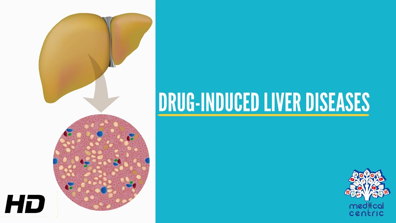 Drug-Induced Liver Disease, Causes, Signs And Symptoms, Diagnosis And Treatment.