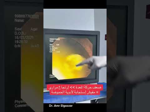 إرتجاع العصارة الصفراوية من أهم اسباب إلتهاب المعدة المزمن