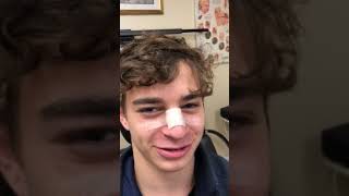 In Office Nasal Fracture Reduction-Good Result