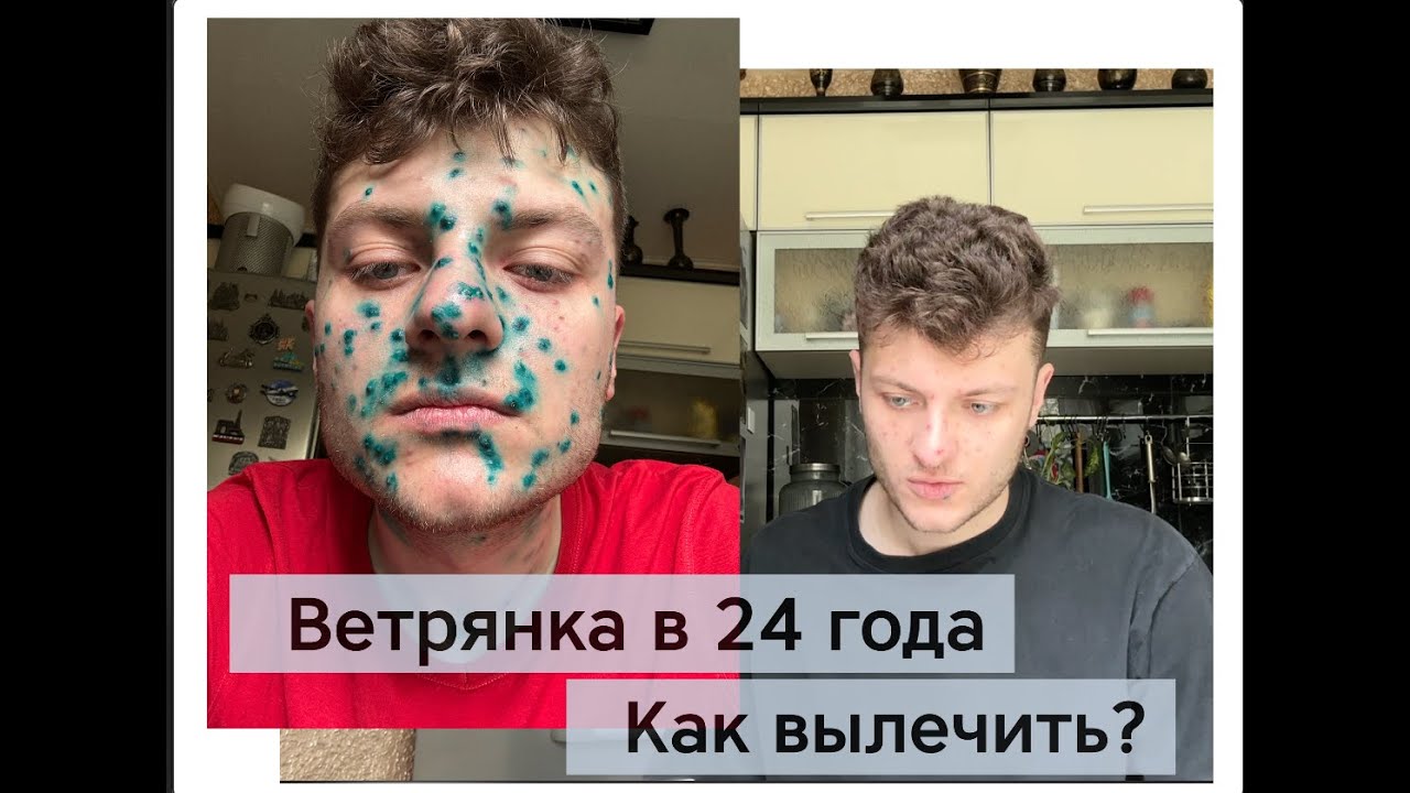 Ветряная оспа в 24 года: лечение ветрянки без паники - YouTube