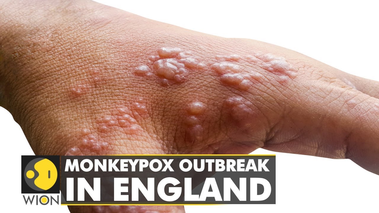 At least 183 Monkeypox cases confirmed in England | Scientists not able to pinpoint source | WION – WION