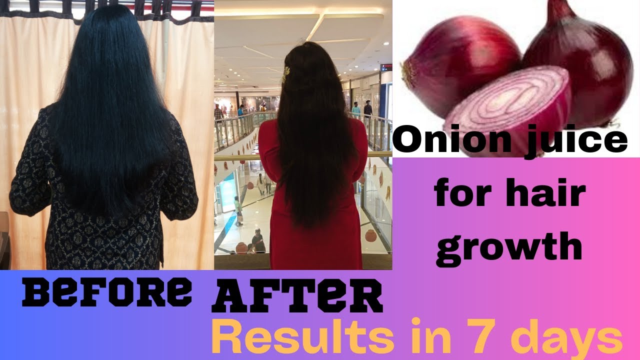 Onion juice for hair regrowth/hairfall/dandruff/greyhair haircare onions YouTube